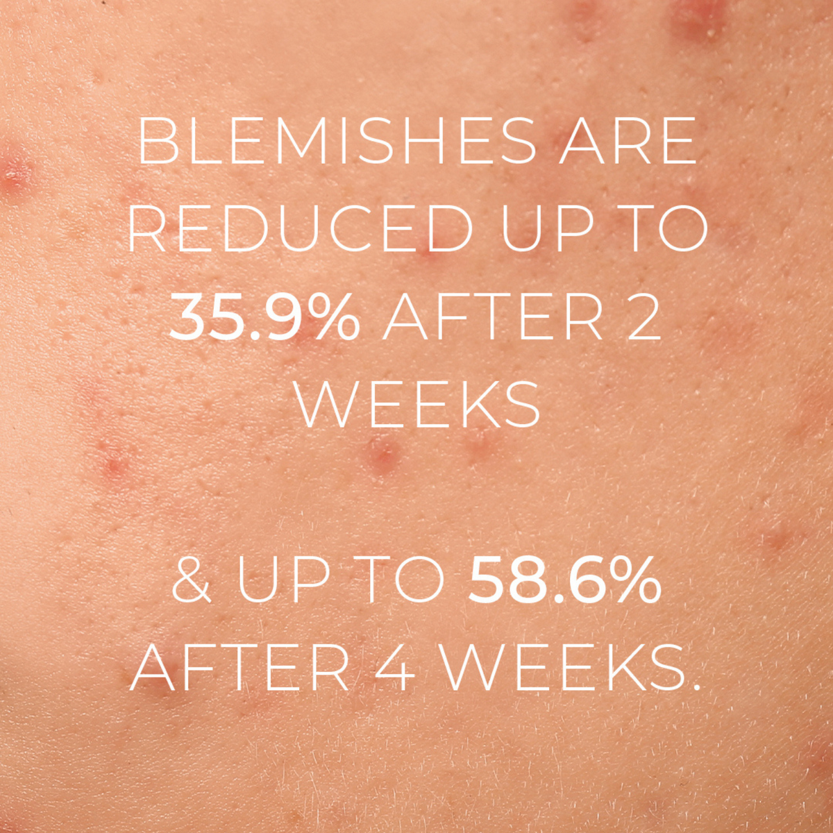 Violet Water D-Spot Clearing Blemish Treatment