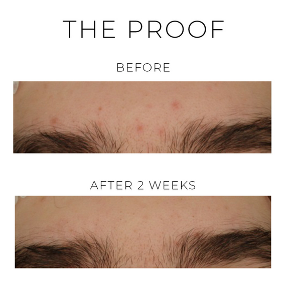 Violet Water D-Spot Clearing Blemish Treatment
